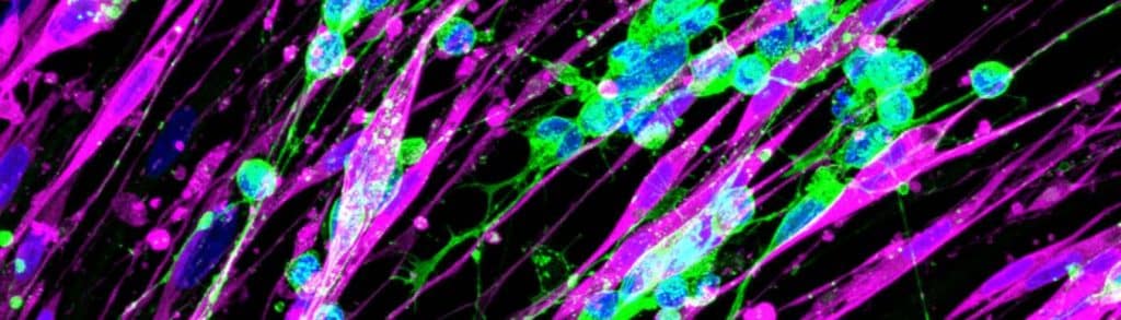 Schwannzellen (magenta) und Tumorwachstum in Neuroblastomen (Tumorzellen in grün) | Foto: St. Anna Kinderkrebsforschung